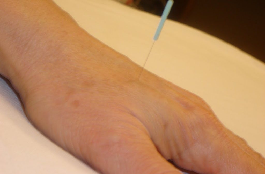 Acupuncture As A Treatment For Fibromyalgia Syndrome
