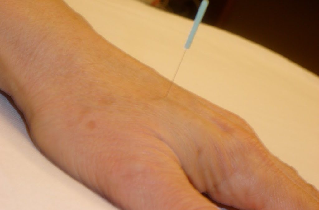 Dental Patients Are Calmed By Acupuncture