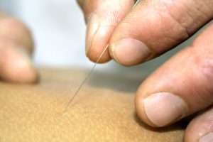 acupuncture-example