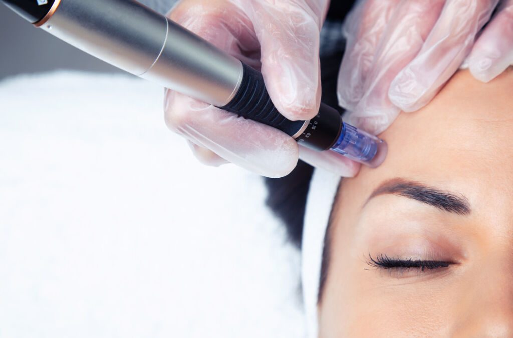 New Micro Needling Research
