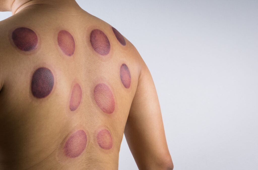 Cupping and Olympic Athletes