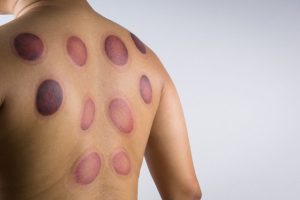 A,Man,Back,With,Blood,Marks,Massaged,After,Taking,Chinese