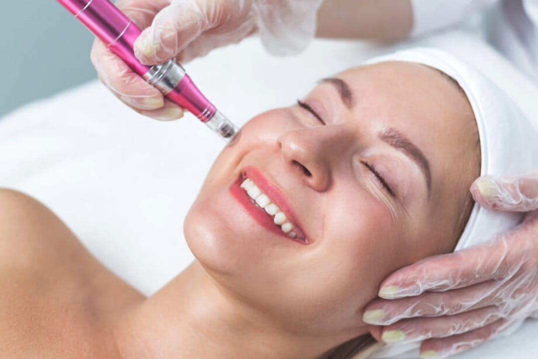 Micro Needling Treatment by Jennifer Dubowsky