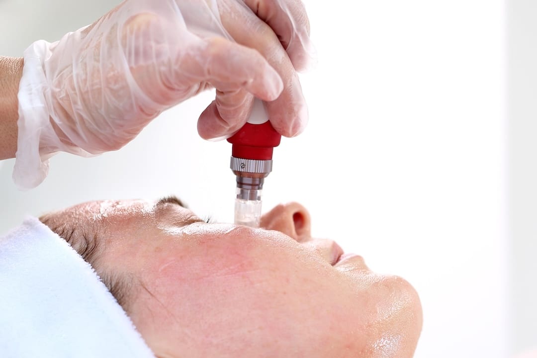 Micro Needling