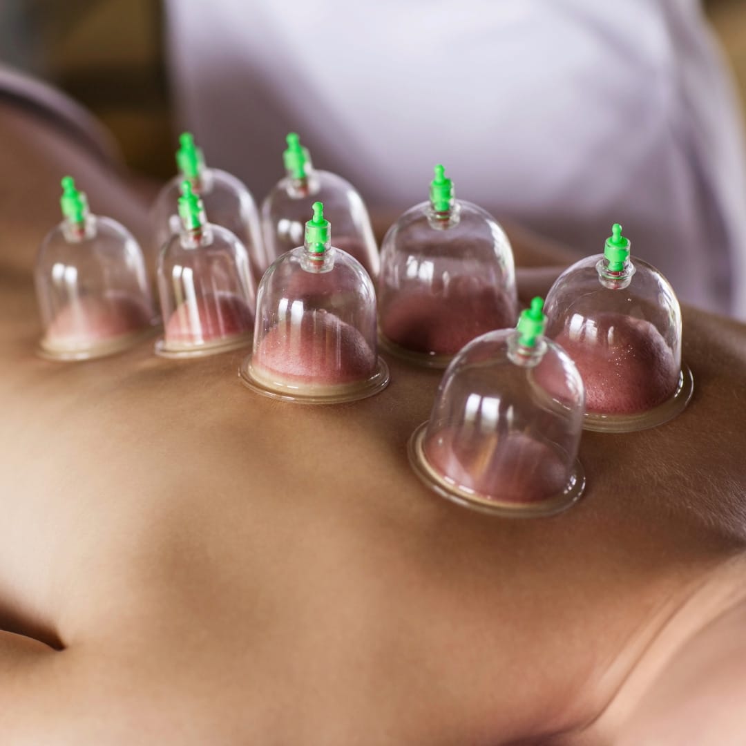 CuppingTherapy Offered By Jennifer Dubowsky Chicago Acupuncturist